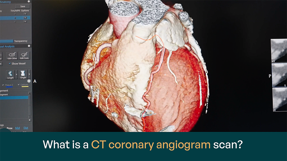 What is a CT coronary angiogram scan? – video with Dr Ravi Assomull